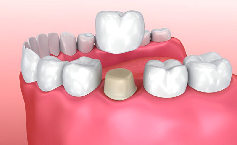dental crowns in crestview fl