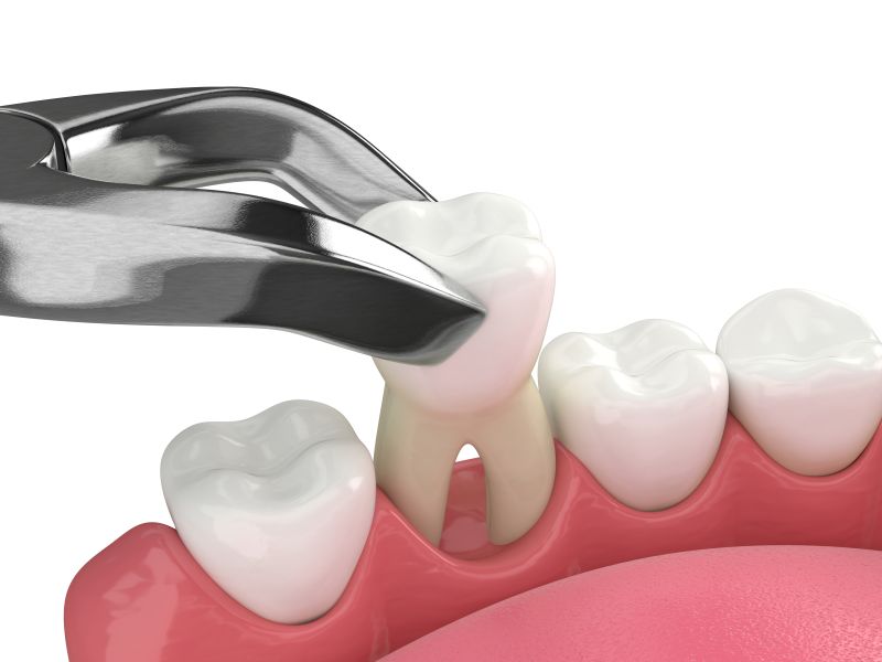 wisdom teeth extractions in crestview fl
