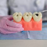 how dental crowns prevent tooth decay