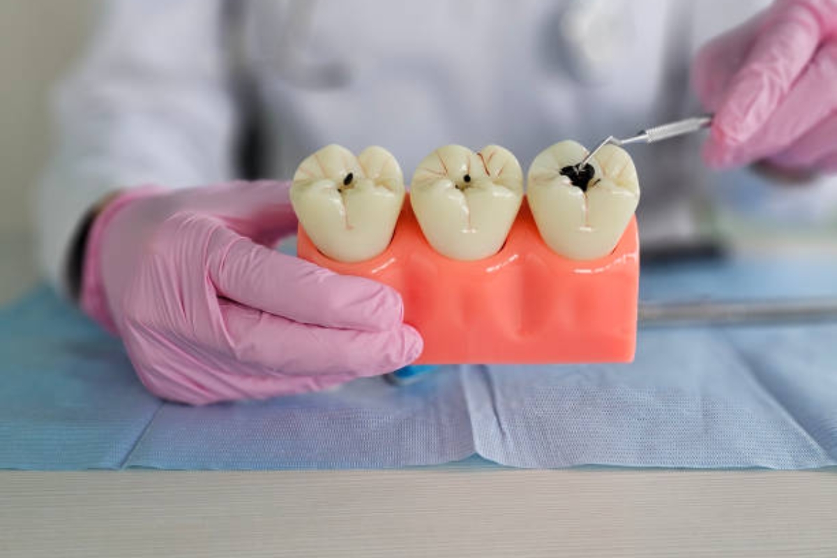 how dental crowns prevent tooth decay